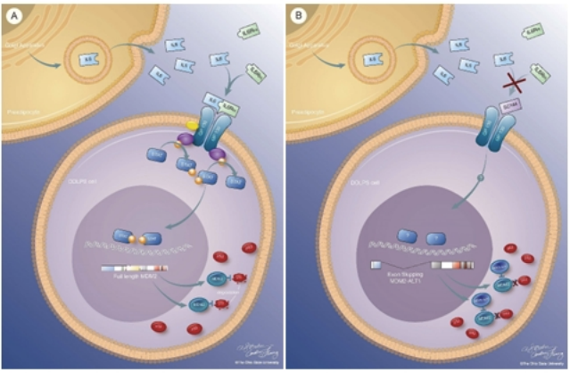 Blockade of Interleukin-6 (IL-6) Signaling in Dedifferentiated Liposarcoma (DDLPS) Decreases Mouse Double Minute 2 (MDM2) Oncogenicity via Alternative Splicing